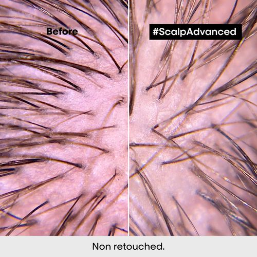 Scalp Advanced & Serioxyl - Scalp Advanced | L'Oréal Partner Shop